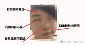 假期里，杭州19岁小伙接连“快活”数日，一觉醒来天塌了：怎么会感染？医生 ...