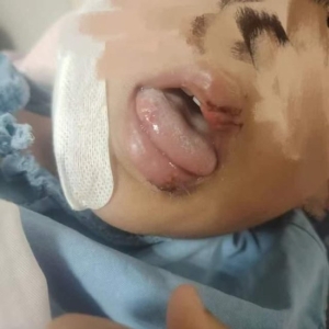 江苏徐州5岁男童被自家哈士奇咬伤面部，家长：孩子缝了近50针，狗已被处理 ...